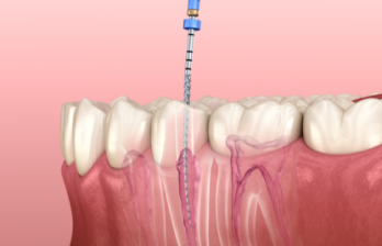 During a root canal treatment a dentist injects medication into the root canal for treatment.