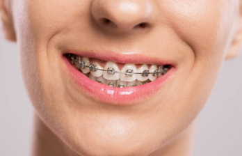 A happy woman wearing braces highlights the successful results of popular dental treatments.