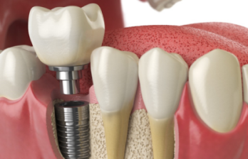A professional dentist performing dental implant surgery to replace missing or damaged teeth