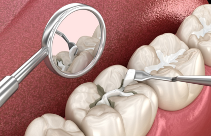 Four teeth during dental filling treatment using tools, two teeth done, and a third in the process.