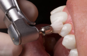 A professional dentist performing a teeth-whitening and bleaching treatment using a dental tool