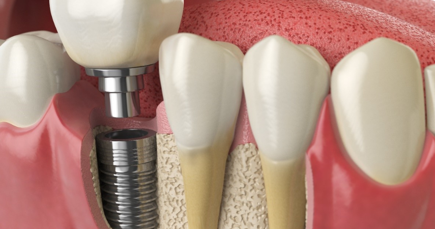 A professional dentist performing dental implant surgery to replace missing or damaged teeth