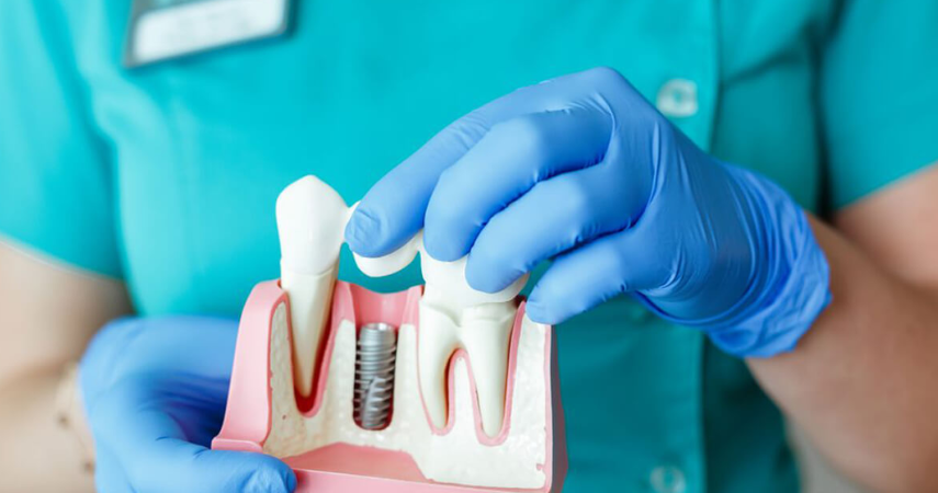 A dentist in blue gloves is holding ceramic crowns and dental bridge replacements for missing teeth