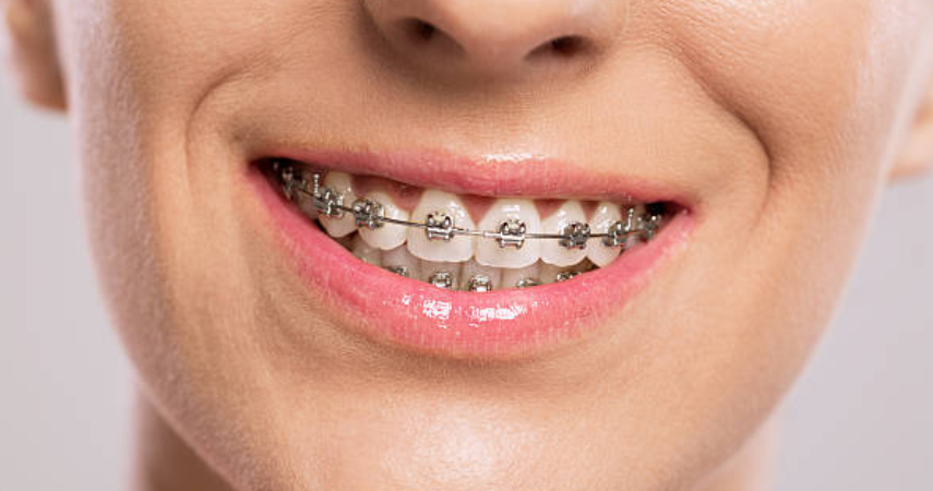 A happy woman wearing braces highlights the successful results of popular dental treatments