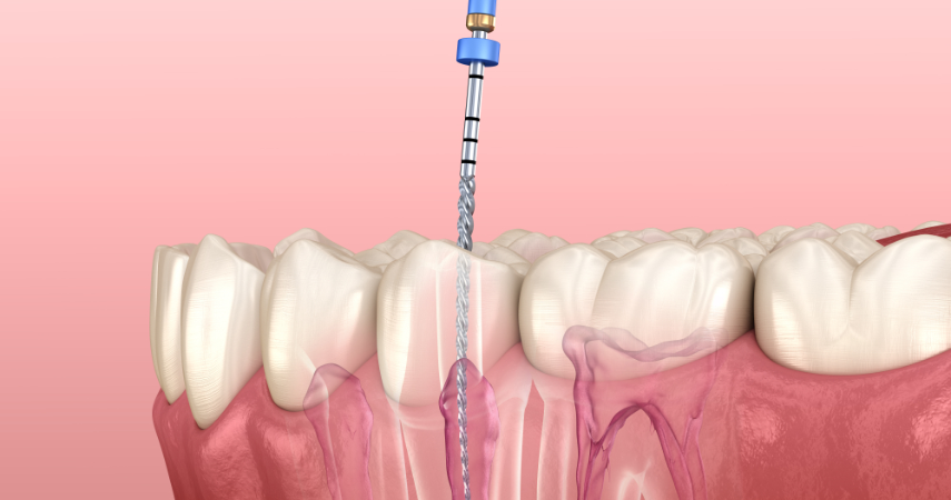 A doctor performs root canal treatment with an injection used inside the root canal treatment