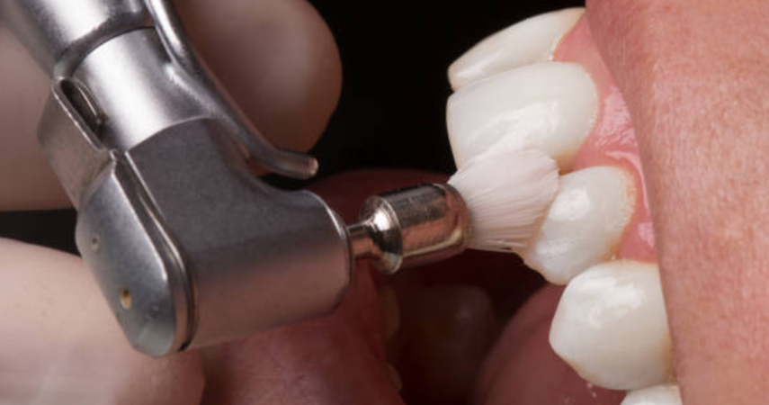  A professional dentist performing a teeth-whitening and bleaching treatment using a dental tool